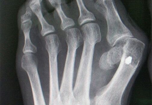 X -ray