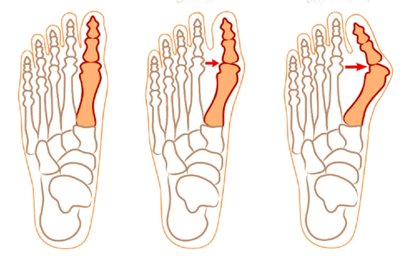 Hallux Valgus Deformitate