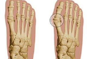 cauzele hallux valgus