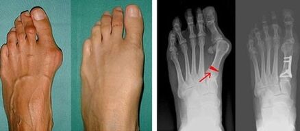 simptome de hallux valgus