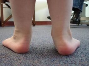 Deformarea piciorului plat valgus la copil