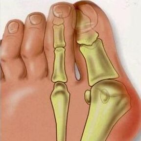 Motivele Valgus