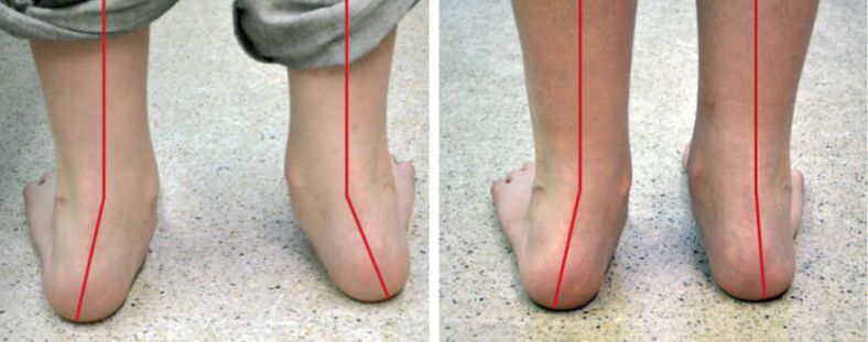 Picioare Valgus