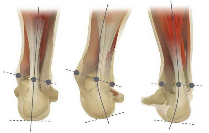 Tipuri de valgus