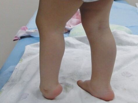 Primele simptome ale deformării valgus a piciorului