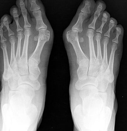 X -RAY OF POOTELULUI
