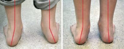 Curbura valgus